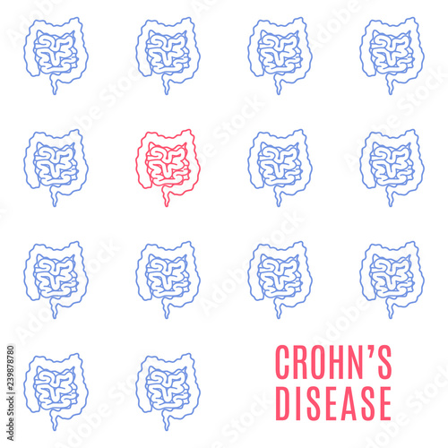 Crohns disease awareness poster. Medical pattern of healthy intestines and one affected by the illness. Inflammatory bowel disease. Human body organ IBD disorder. Vector illustration.