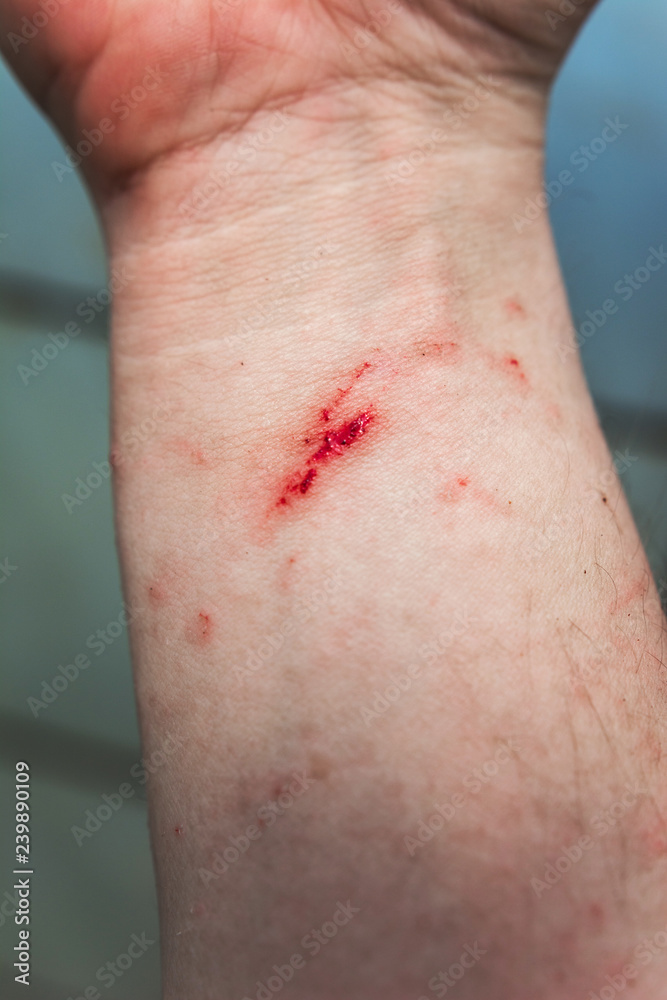 drop of blood on the incised wound on the palm of your hand. drop of blood on the incised wound on the palm of your hand.