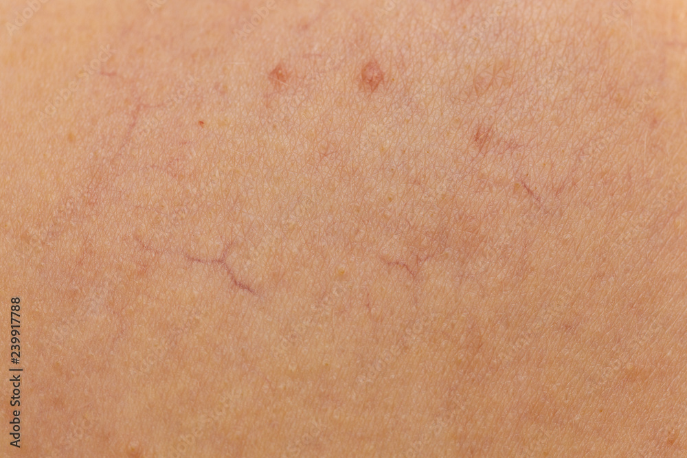 Ski with dilated capillaries ad red spots Ski with dilated capillaries ad red spots