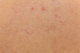 Ski with dilated capillaries ad red spots