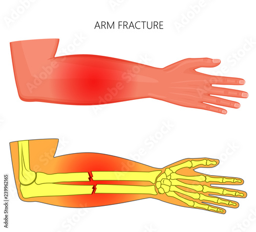 Vector illustration of a human arm with shaft fracture injury of ulnar and radius tubular bones and area of pain.  For advertising, medical publications, use on package of medicinal products