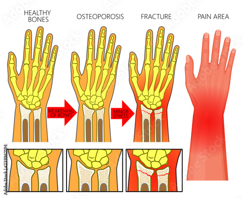 Vector illustration of a healthy human arm, with osteoporotic injury, with ulnar and radius bones fractures in spongy part and area of pain