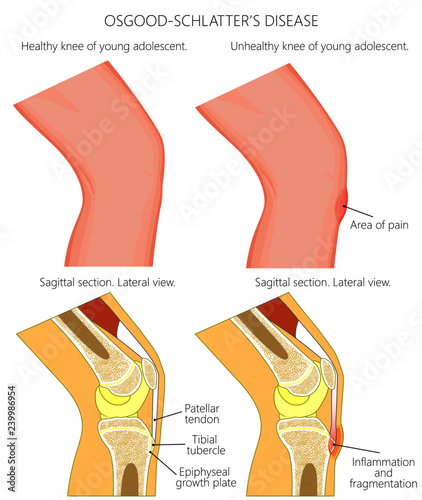 Vector illustration of a healthy adolescent knee and unhealthy knee with Osgood schlatter disease. Anatomy of human knee, external view and lateral view of  sagittal section of the knee.