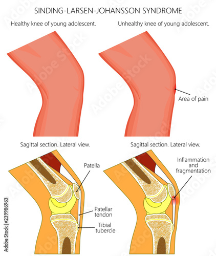 Vector illustration of a healthy adolescent knee and unhealthy knee with Sinding Larsen Johansson syndrome. Anatomy of human knee, external view and lateral view of  sagittal section of the knee.