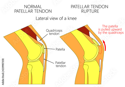 Vector illustration of a healthy knee joint and an unhealthy knee with a  patellar tendon rupture problem. Anatomy of the human knee, side view of the bent knee