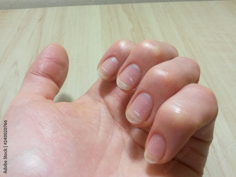 Spring avitaminosis of nails Spring avitaminosis of nails