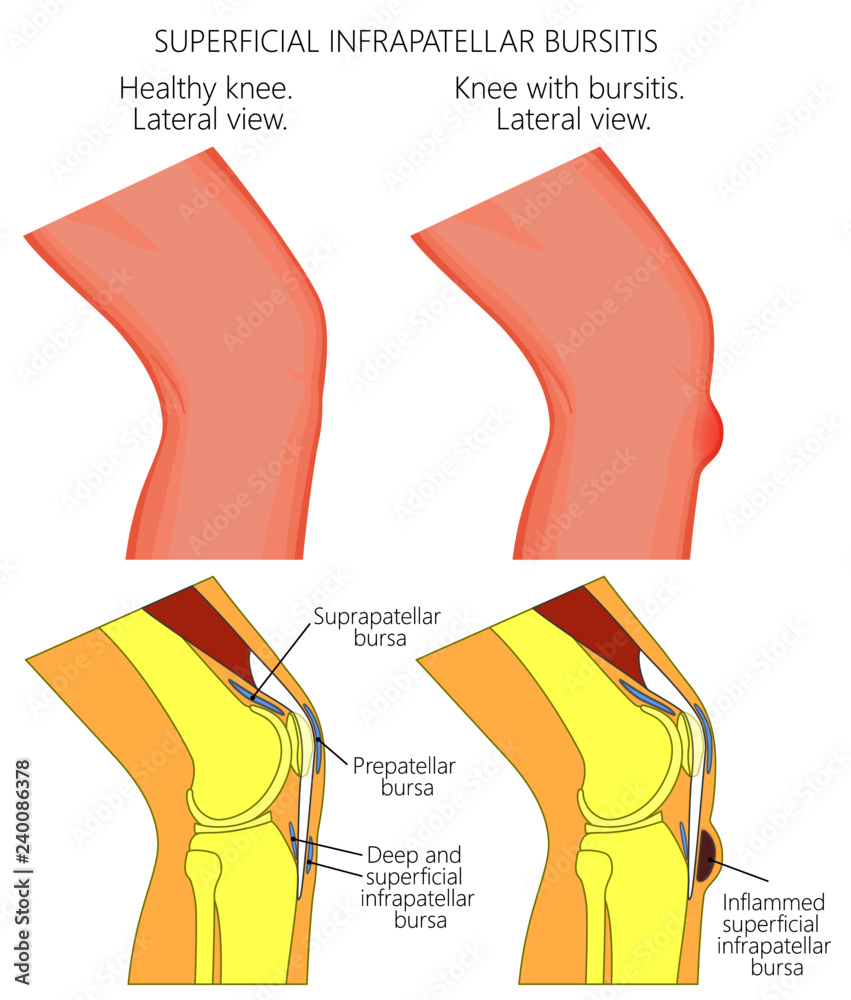 Vector illustration of a healthy knee and unhealthy knee with