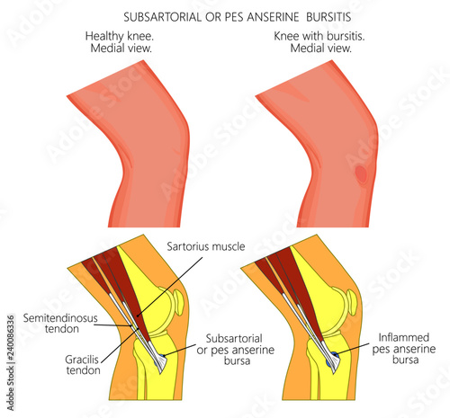 Vector illustration of a healthy knee and unhealthy knee with Subsartorial or pes anserine bursitis or breaststroke swimmer knee. Anatomy of human knee joint, external view and medial or side view.