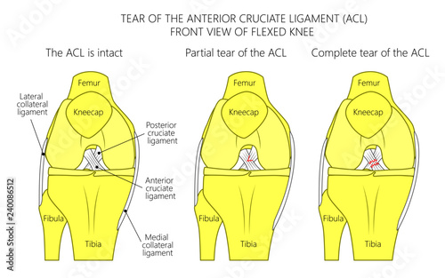 Vector illustration of a healthy knee joint with intact, partial tear of anterior cruciate ligament and complete tear of ACL. Anterior or front view of flexed knee. For medical publications.