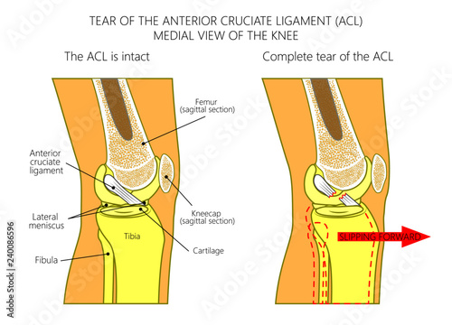 Vector illustration anatomy of a knee joint with healthy and torn anterior cruciate ligament. Side or medial view of straight knee with sagittal section of femur bone. For medical publications photo