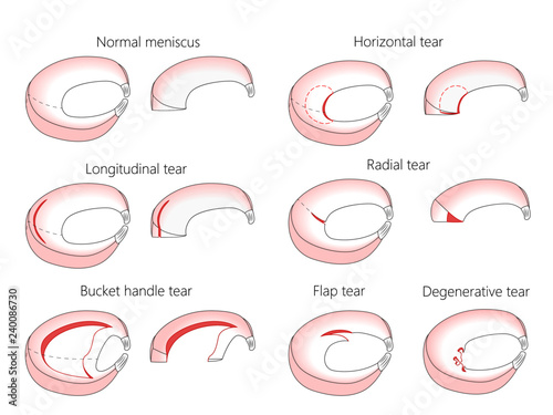 Vector illustration. Anatomy of a meniscus in the healthy human knee joint. Types of meniscal tear with cross section of the menisci. For advertising, medical publications photo