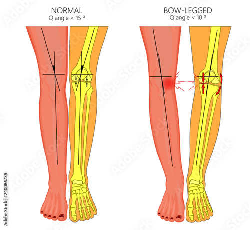 Vector illustration diagram. Shapes of human legs. Normal and curved legs. Knock knees. Bowed legs. Genu valgum and genu varum.  For advertising, medical publications