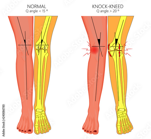 Vector illustration diagram. Shapes of human legs. Normal and curved legs. Knock knees.  Genu valgum and genu varum.  For advertising, medical publications
