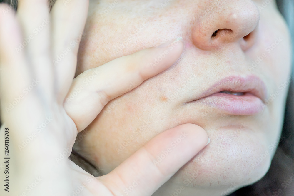 Naklejka premium a birthmark or a mole on a woman skin