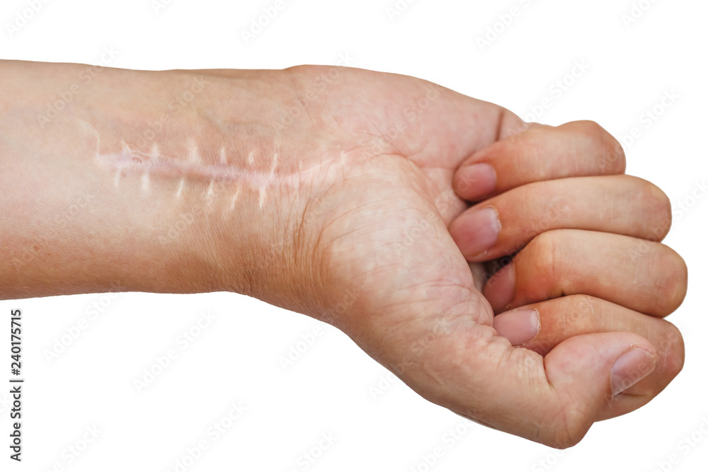 Fototapeta premium Scar with stitches on the wrist after surgery. Fracture of the bones of the hands in fist isolated on white background