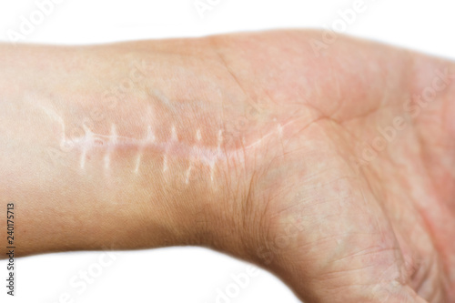 Scar with stitches on the wrist after surgery. Fracture of the bones of the hands in fist isolated on white background