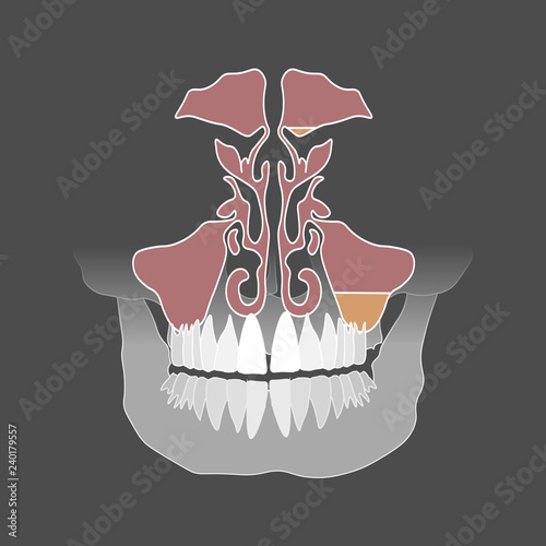 Flat style. Odontogenic sinusitis. Inflammation of the maxillary sinuses due to a disease of the roots of the tooth