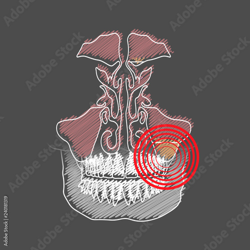 Stylized hatching of the Odontogenic sinusitis. Inflammation of the maxillary sinuses due to a disease of the roots of the tooth with a point of pain and inflammation.