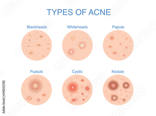 Types of Acne icon for skin problems content. Illustration about dermatology diagram.