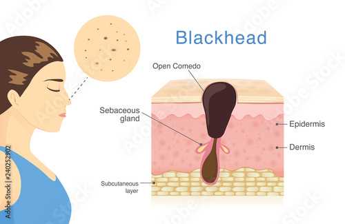 Woman have Blackhead Acne on her nose with skin layer and description. Illustration about medical diagram.
