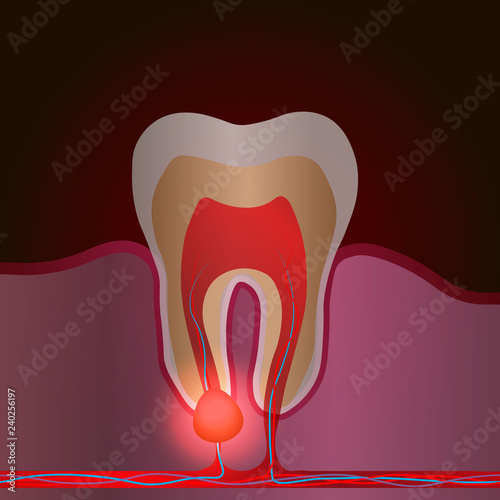 dental disease with pain and inflammation. Medical illustration of tooth root inflammation, tooth root cyst, pulpitis. photo