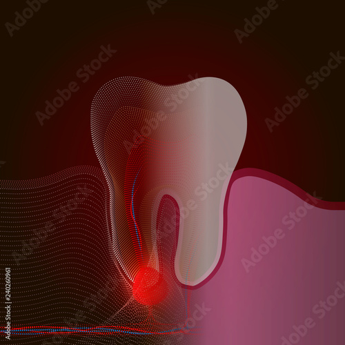 The transition from a real tooth to a point X-ray effect with a point of pain and inflammation. Medical illustration of tooth root inflammation, tooth root cyst, pulpitis.