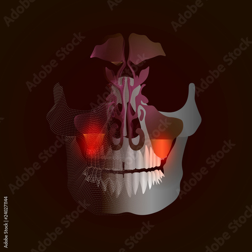 The transition from a real image to a linear x-ray effect with a point of pain and inflammation. Odontogenic sinusitis. Inflammation of the maxillary sinuses due to a disease of the roots of the tooth