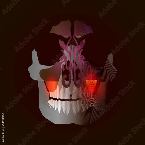 The transition from a real image to a linear x-ray effect with a point of pain and inflammation. Odontogenic sinusitis. Inflammation of the maxillary sinuses due to a disease of the roots of the tooth