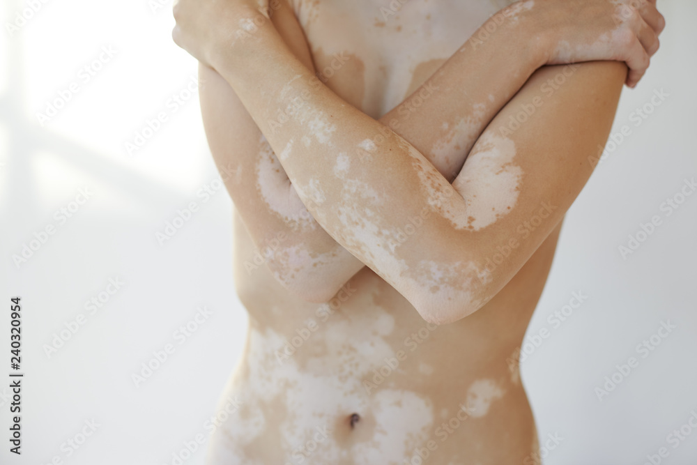 Naklejka premium People, health, illness, skin disorders and auto immune disease concept. Cropped studio picture of unknown female crossing arms on her chest, demonstrating skin affected with vitiligo white spots