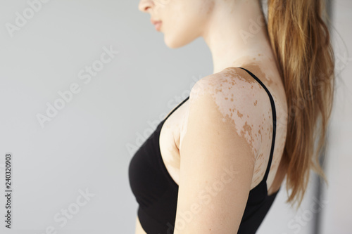 Profile picture of unknown young female having vitiligo disease, dressed in black top, posing at blank studio wall with copyspace for your promotional content. Selective focus on woman's shoulder photo