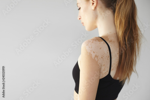 Side view of gorgeous slender young European woman with long ponytail looking down, showing white vitiligo spots on her back and arm. People, dermatology, beauty, depigmentation and skin disorder photo