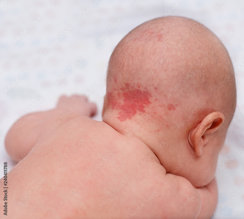 Hemangioma, benign tumor on the back of the head in an infant. Stock Photo Adobe Stock