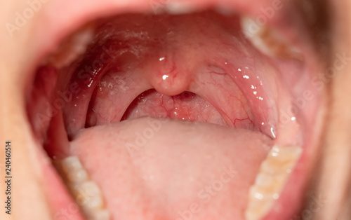 Sore throat with throat swollen. Closeup open mouth with posterior pharyngeal wall swelling and uvula and tonsil. Influenza follicles in the posterior pharyngeal wall. Macro shot of lymphoid follicles photo