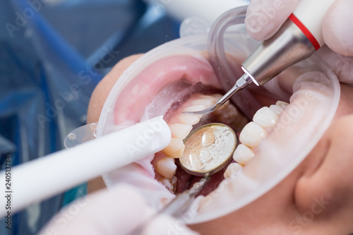 Closeup of modern professional teeth cleaning in dentistry with specialized equipment. The patient is wearing a retractor