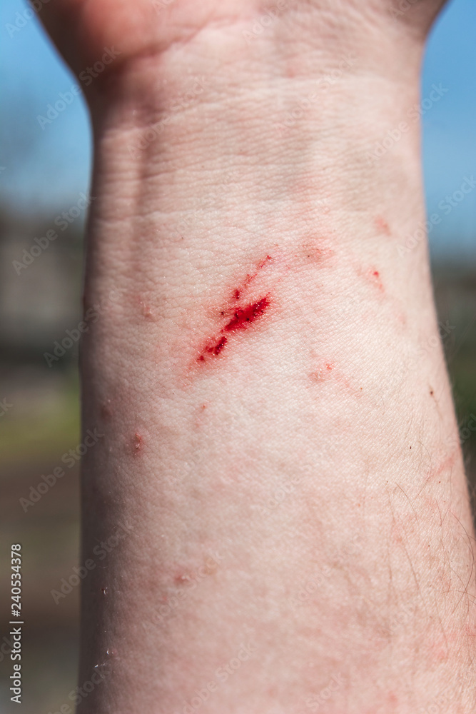 drop of blood on the incised wound on the palm of your hand. drop of blood on the incised wound on the palm of your hand.