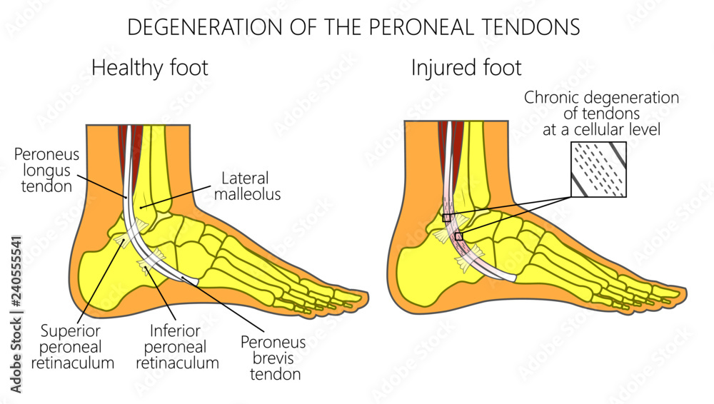 Vector illustration of Peroneal Tendon Injuries. Degeneration of the ...