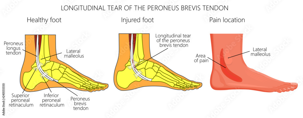 Vector illustration of Peroneal Tendon Injuries. Longitudinal tear of ...
