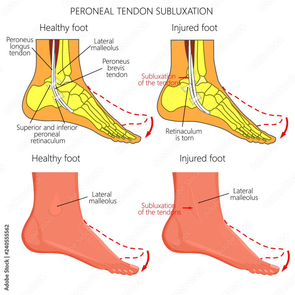 Vector Illustration Of Peroneal Tendon Injuries Peroneal Tendon Dislocation Or Subluxation When
