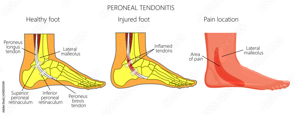 Vector illustration of Peroneal Tendon Injuries. Peroneal tendonitis ...