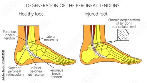 Vector illustration of Peroneal Tendon Injuries. Degeneration of the peroneus longus and brevis tendons. Tendinosis or tendinopathy. Lateral ankle injury. photo