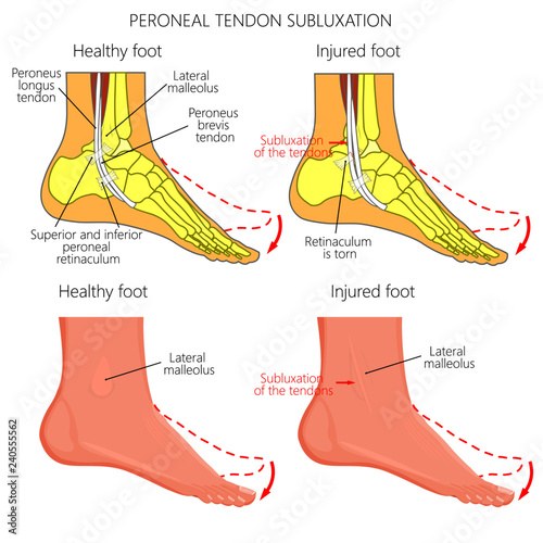 Vector illustration of Peroneal Tendon Injuries. Peroneal tendon ...