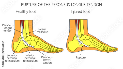 Vector illustration of Peroneal Tendon Injuries. Rupture of the peroneus longus tendon. Lateral ankle injury.