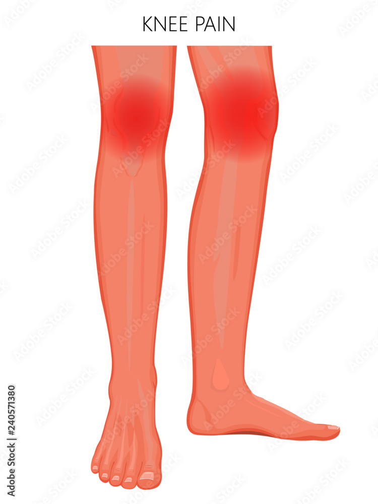 Vector illustration of a human legs (anterior and medial view) with knee joint pain or injury. For advertising, medical (health care) publications Vector illustration of a human legs (anterior and medial view) with knee joint pain or injury. For advertising, medical (health care) publications