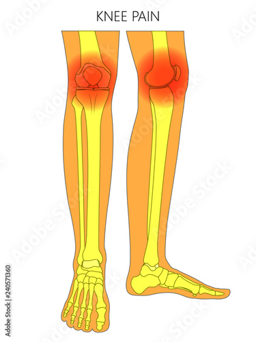 Vector illustration of bones of a human legs (anterior and medial view) with knee joint pain or injury. For advertising, medical (health care) publications