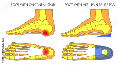 Vector illustration. Human foot with calcaneal spur, plantar fasciitis problem before, after heel pain relief pad. Medial, side and plantar view of a foot. For medical publications