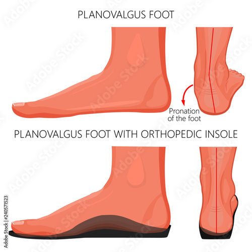 Vector illustration of Flat or planovalgus foot  without and with orthopedic insole. Side (medial) and back views. For advertising and medical publications