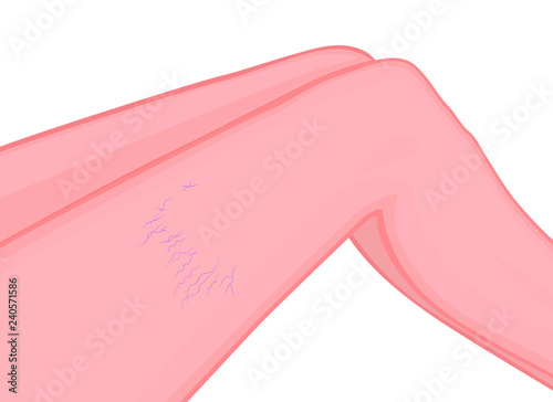 Vector illustration of a human body problem. Varicose and spider veins on woman leg. For advertising and medical publications