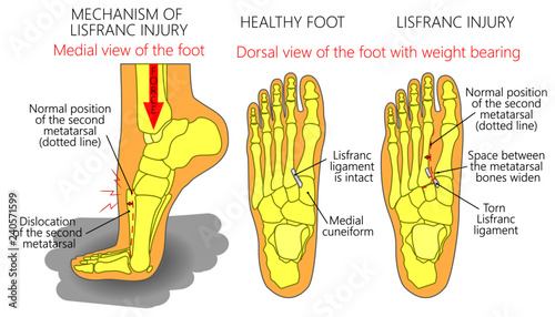 Vector illustration of a healthy human foot and a foot with lisfranc injury with weight bearing and mechanism of injury, dislocation of the second metatarsal bone. Medial, top view of the foot photo