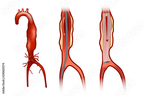 Endovascular aneurysm repair (or endovascular aortic repair) (EVAR)