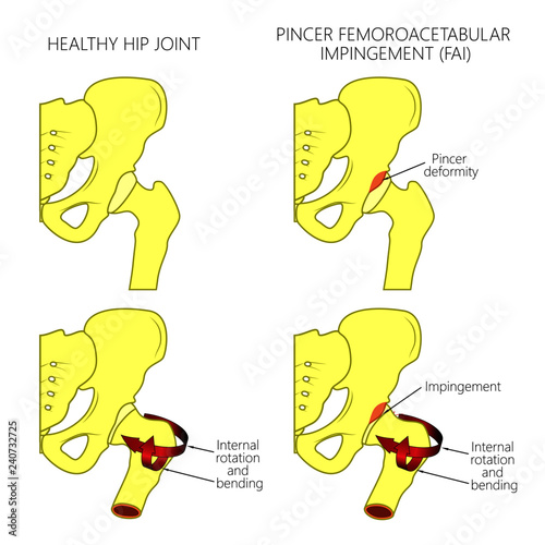 Vector illustration of a healthy human hip joint and a hip with pincer femoroacetabular impingement. Front view of hip joint. For advertising and medical publications.